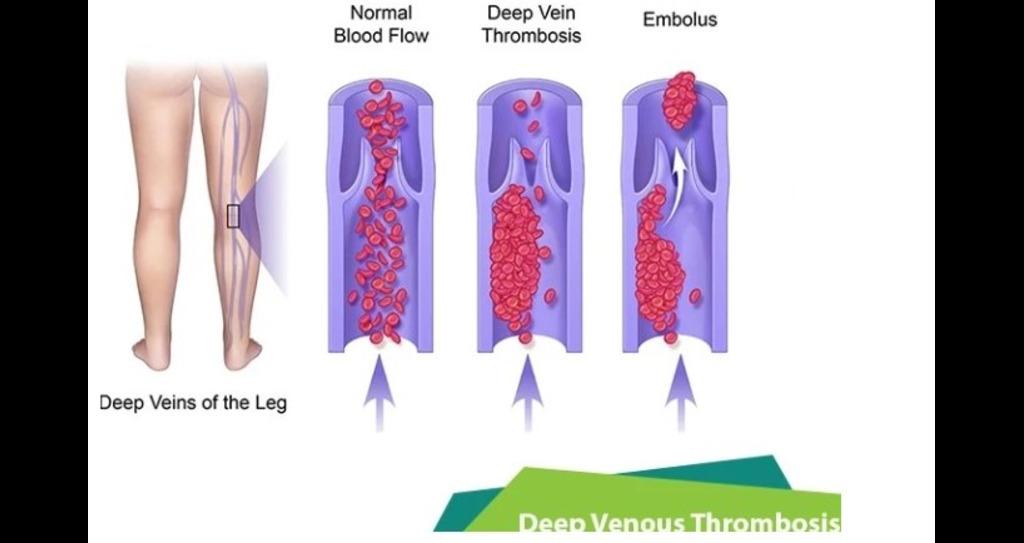 Deep vein thrombosis (DVT) Prevention: Intermittent Pneumatic Compression